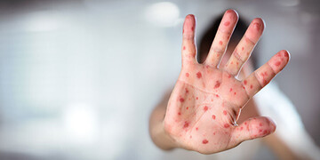 بازگشت سرخک به فارس؛ چرخه واکسیناسیون سرخک باید سریعتر تکمیل شود